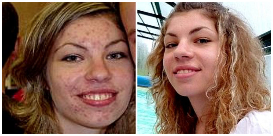 True Beauty Detox Story: Cindy Cleared Up Her Acne For Good (dramatic pics!)