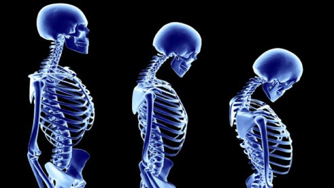 Osteoporosis: The Real Causes and Unexpected Product that Might Contribute Most