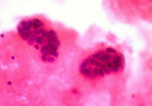 Should You Get a Mammogram?