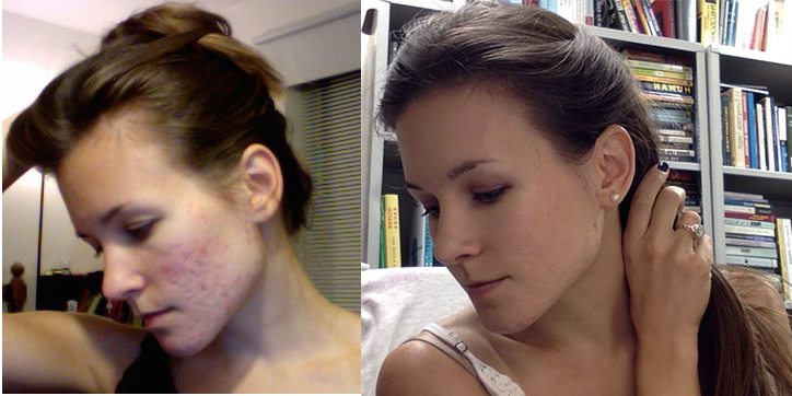 Beauty Detox Transformation Story: Meet Mary!