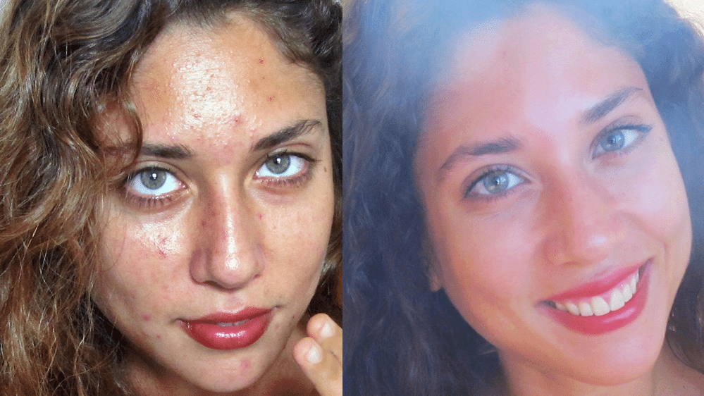 Picture of Shir before and after starting Beauty Detox