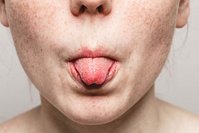 5 Warning Signs Your Tongue is Telling You about Your Health & Digestion « Solluna by Kimberly Snyder